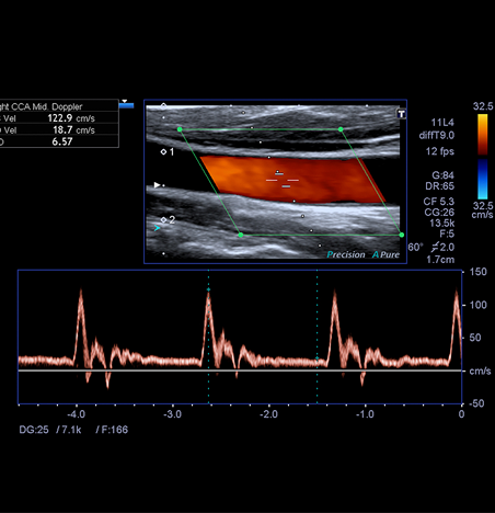 echographie-doppler-1